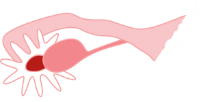 卵巣痛